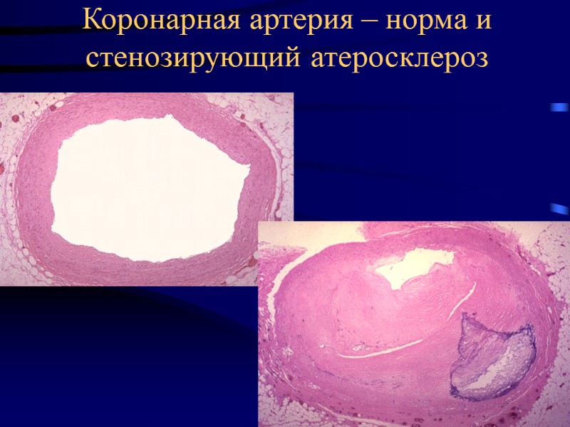 Коронарная артерия – норма и стенозирующий атеросклероз